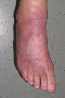 Acrodermatitis chronica atrophicans in a 70-year-old female patient.