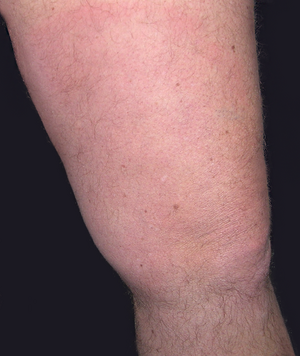 Erythema migrans on the left thigh (Enlarges Image in Dialog Window)