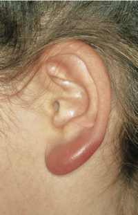 © Hasel Druck & Verlag GmbH Borrelien-Lymphozytom am linken Ohr