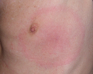 Erythema migrans on the left breast (Enlarges Image in Dialog Window)