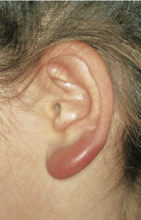 Borrelia lymphocytoma on the left ear